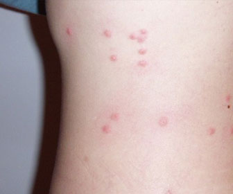 Photo of some nasty flea bites on a human