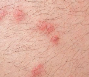 Photo of red marks caused by pulex irritans