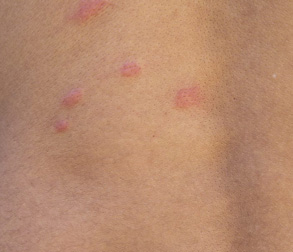 Photo of flea bites on a human back